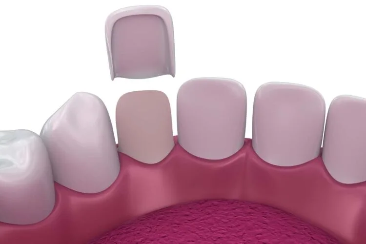 Hollywood Smile Türkei: Lächeln wie die Großen! 2 Hollywood Smile Tuerkei veneers