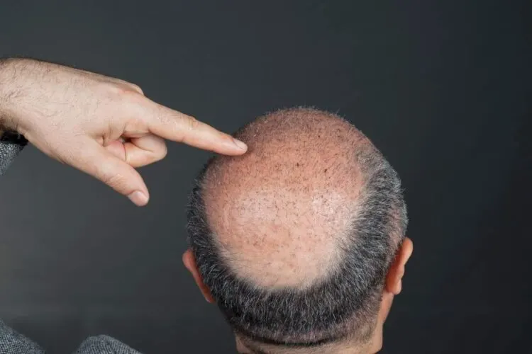 Haartransplantation Türkei – Volles Haar Und Urlaub Inklusive 1 Wann Kommt Eine Haartransplantation Infrage