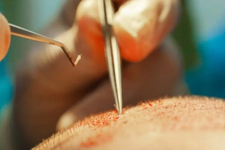 Haartransplantation Türkei – Volles Haar Und Urlaub Inklusive 2 Wie Funktioniert Eine Haartransplantation