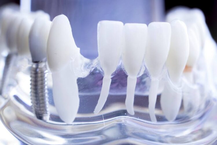 Zaehne Machen Lassen In Der Tuerkei Zahn Implantat