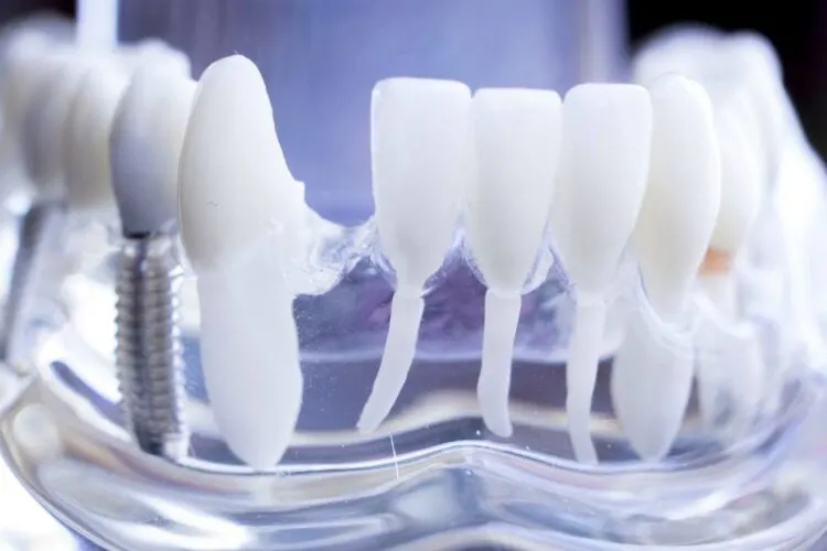 Zähne machen lassen in der Türkei – Implantate und Veneers zu günstigen Preisen 8 Zaehne machen lassen in der tuerkei zahn implantat